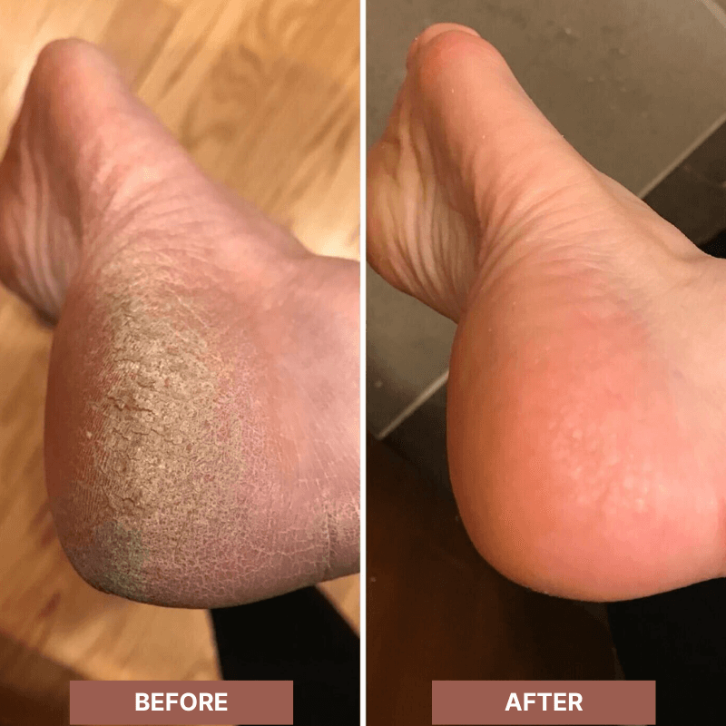 Padicure Electric Callus Remover